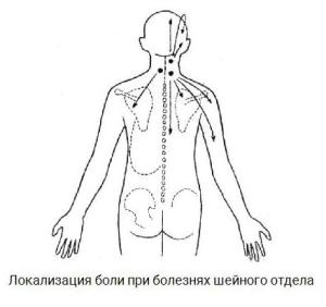 шейный остеохондроз